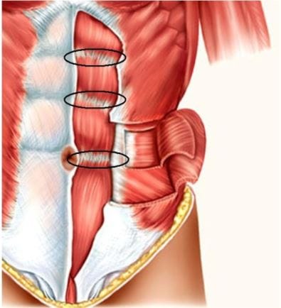Bauchmuskel - Die Muskelfasern